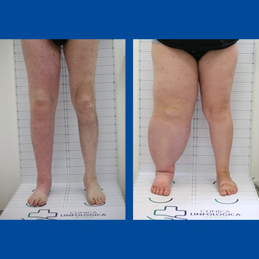 Gamba destra gonfia prima e dopo