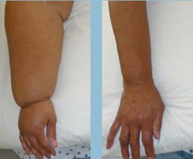 Braccio e mano gonfi