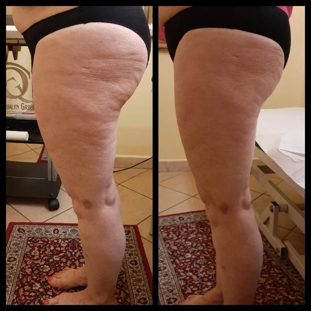 Prima e dopo di pelle più liscia e tonica